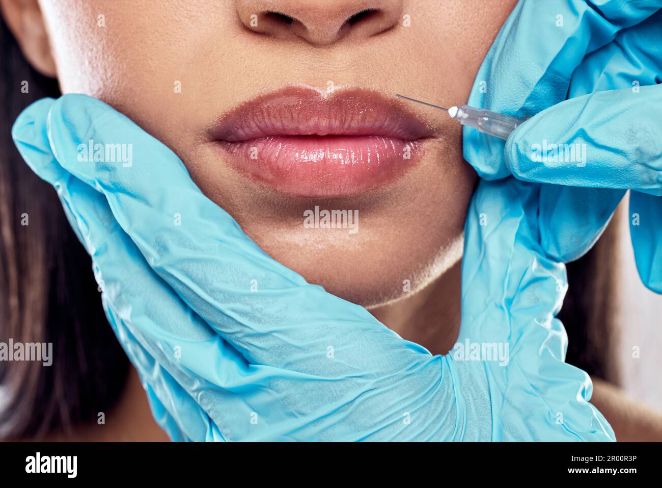Erasing all fine lines. a woman having her lips injected with filler