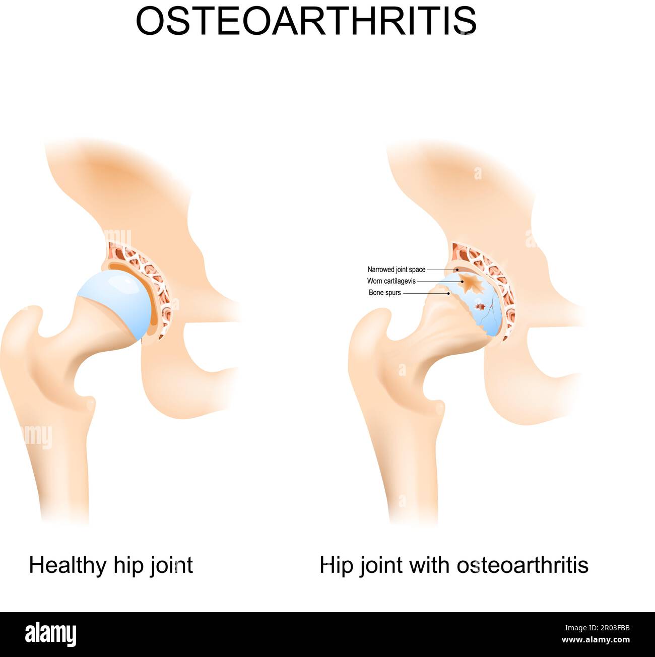 Hip joint with osteoarthritis with femoral head and the acetabulum of the pelvis. A comparison between a healthy hip joint and one with osteoarthritis Stock Vector