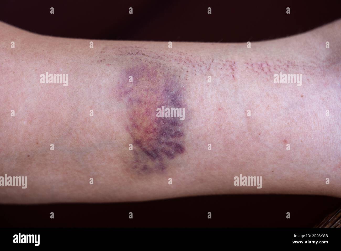 Purple bruise hires stock photography and images Alamy