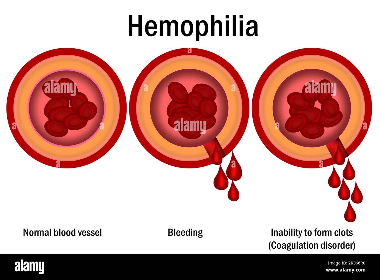 Hemophilia. damaged blood vessel concept isolated, 3d rendering Stock