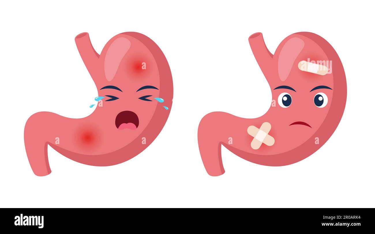 Esophageal Ulcer Stock Vector Images Alamy esophageal-ulcer-stock-vector-images-alamy