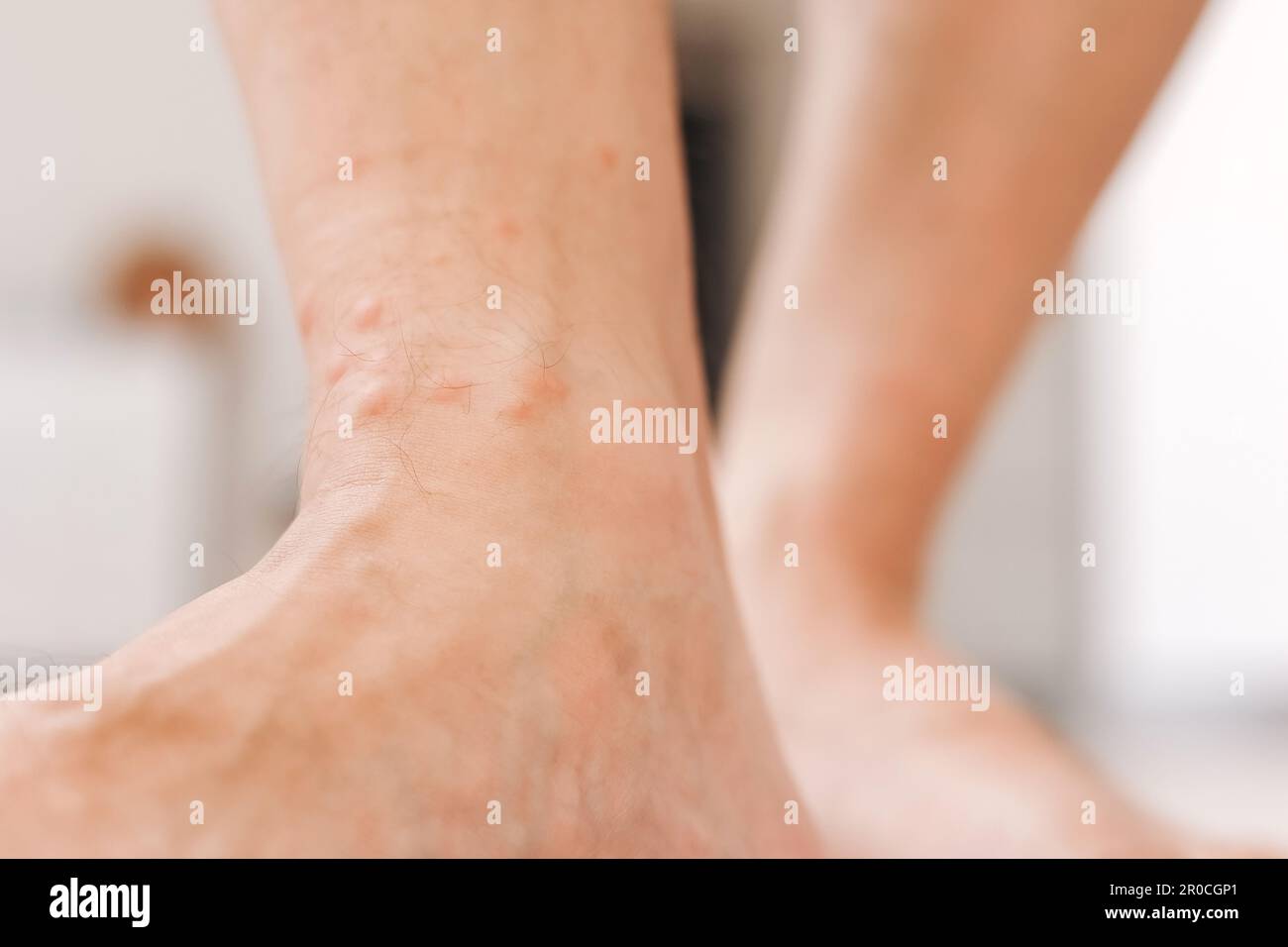 Close up allergic rash dermatitis eczema on man foot. Leg with red rash