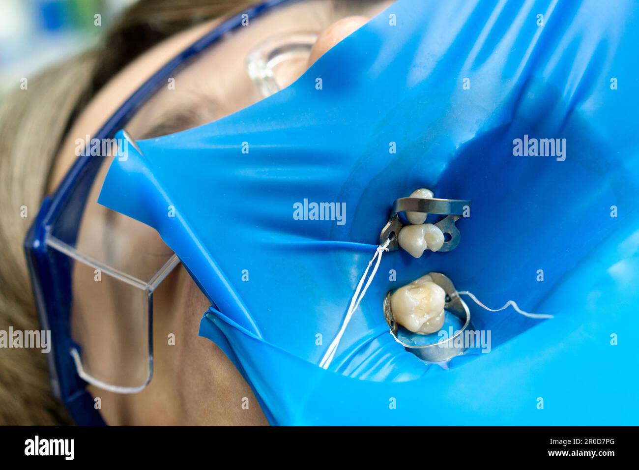 Isolation tooth female patient for medical manipulations using rubber