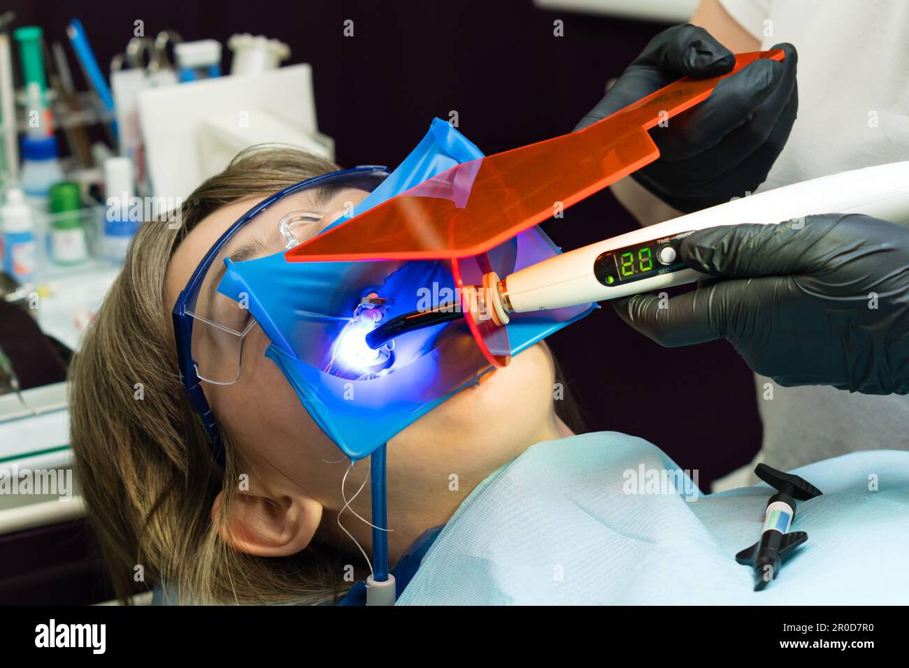 Restoration chewing surface with photopolymer filling material. Dentist