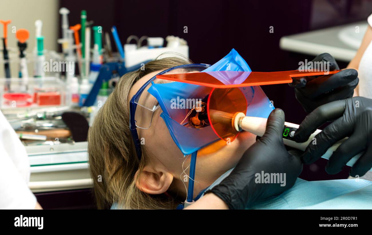 Restoration chewing surface with photopolymer filling material. Dentist ...