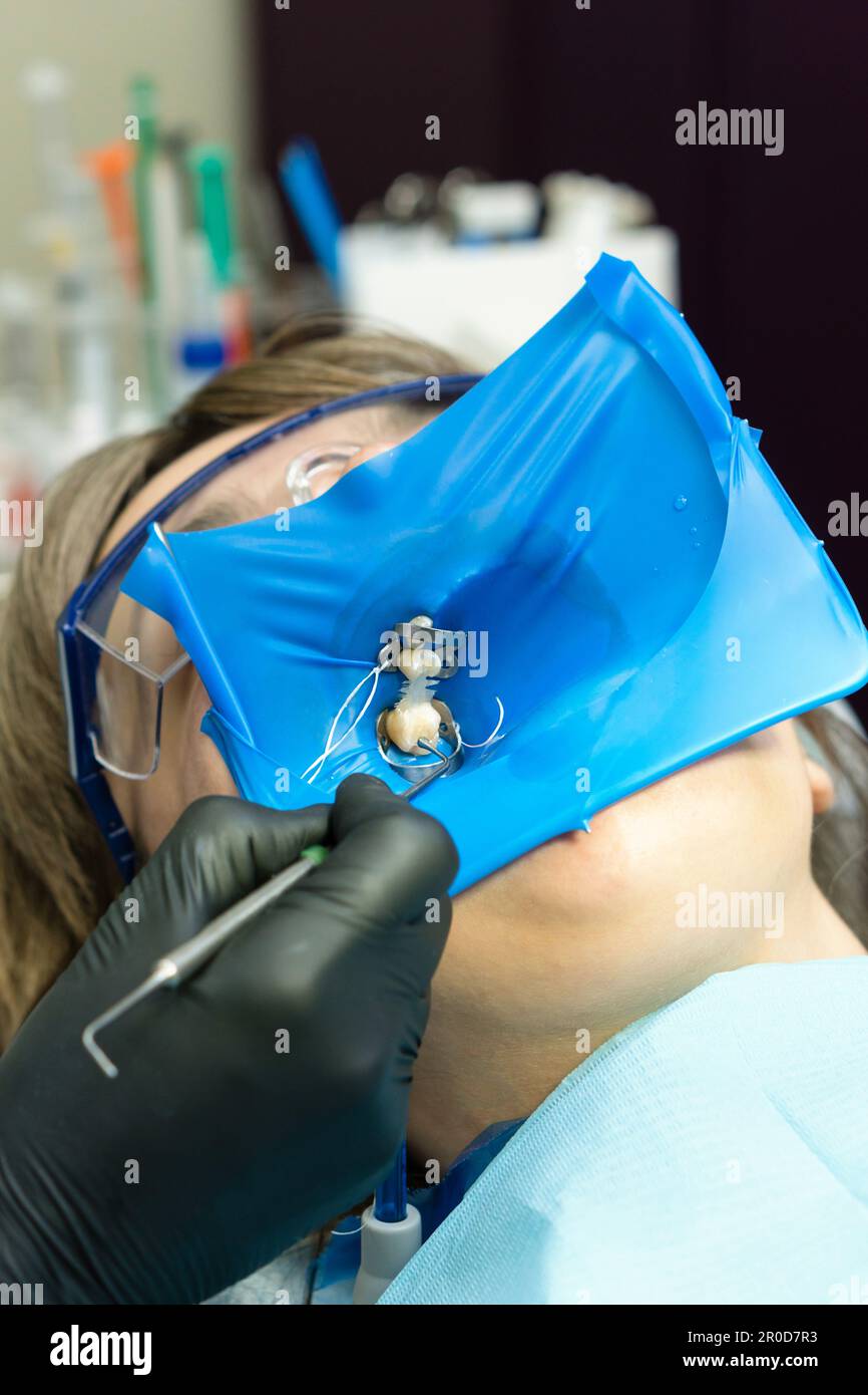 Doctor dentist using of rubber dam system with latex scarves and metal