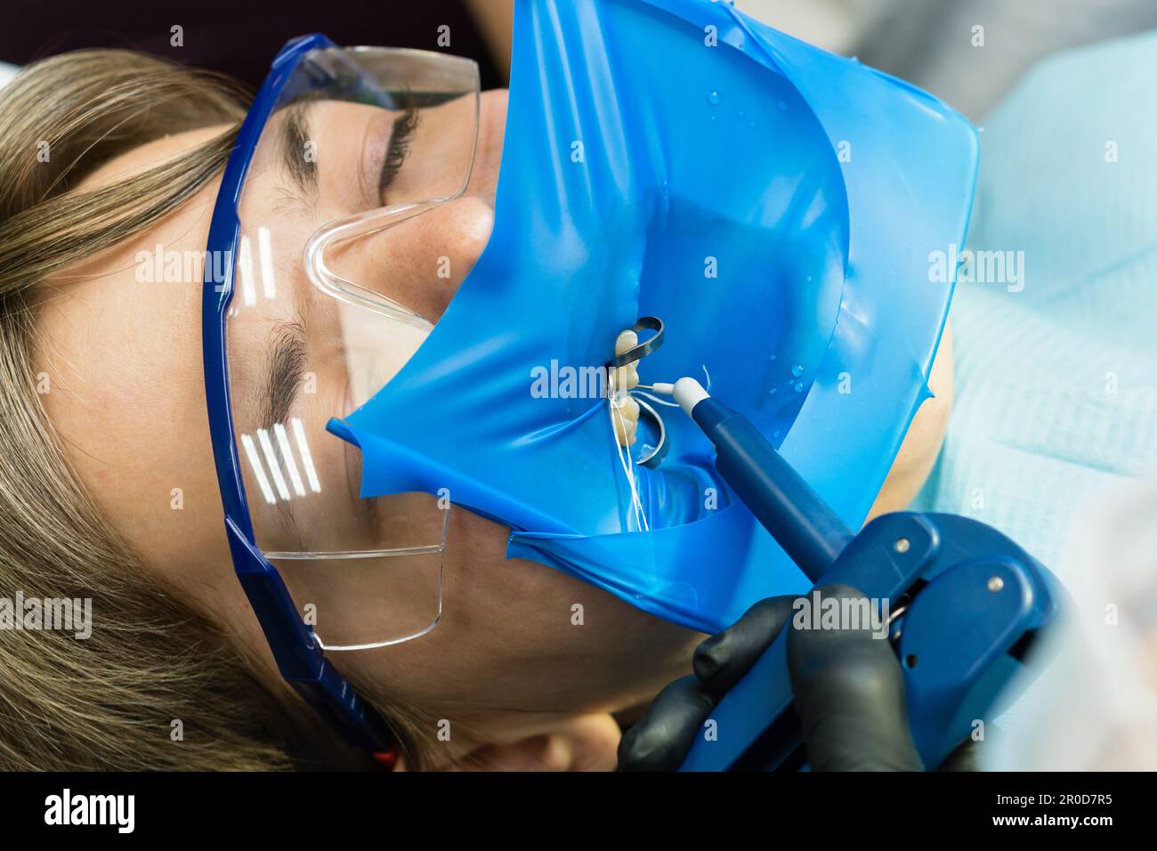 Doctor dentist using of rubber dam system with latex scarves and metal