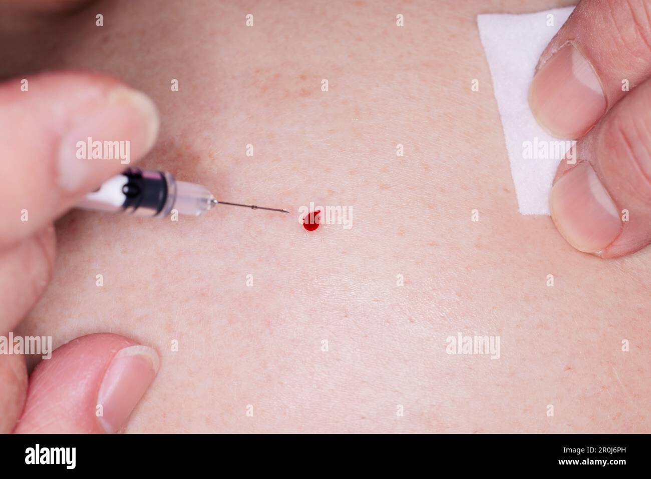 Close up of needle withdrawn from injection site leaving a drop of blood on the abdomen Stock Photo