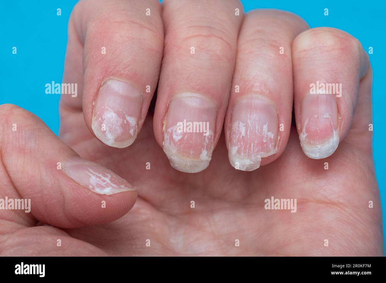 Premium Photo | Closeup healthy natural woman's nails without nail polish  remove gel polish grey background