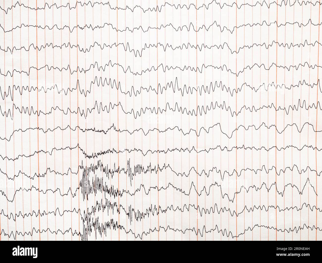 encephalogram on paper record of electrical activity of brain Stock