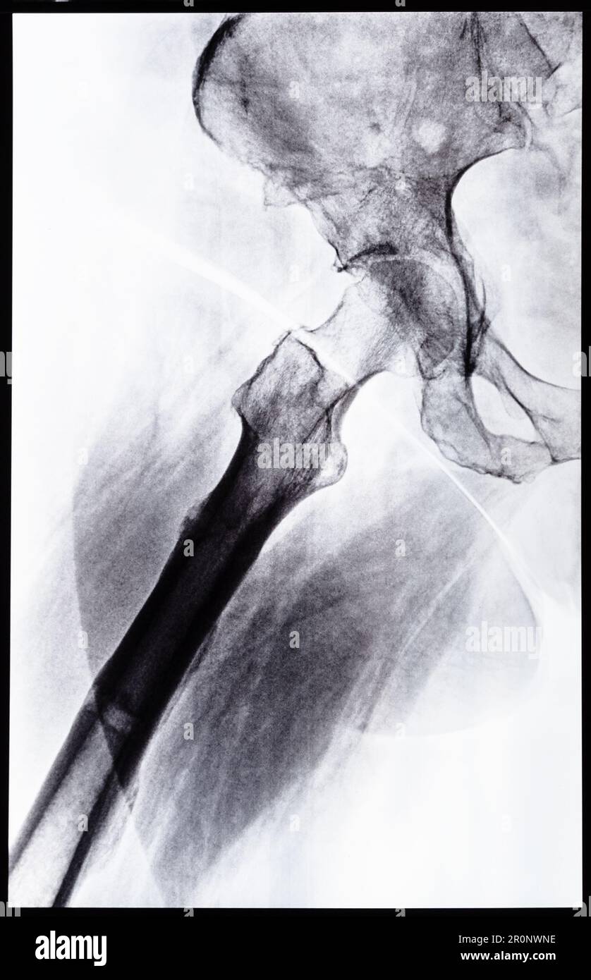 x-ray side view of junction of tibia and pelvis after healed of fracture of acetabular cavity Stock Photo