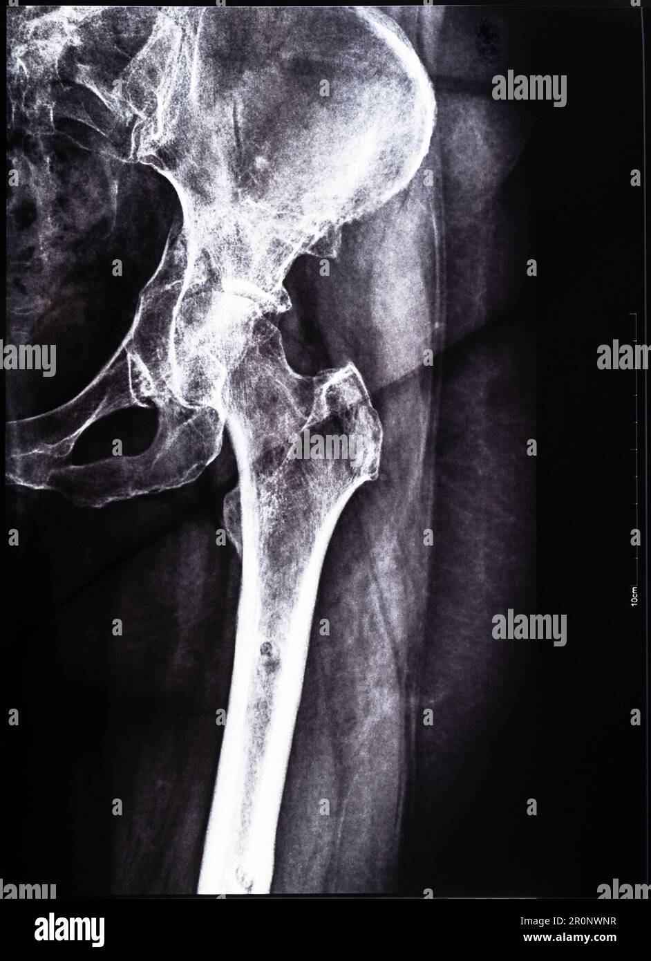 negative x-ray of junction of tibia and pelvis after healed of fracture of acetabular cavity Stock Photo