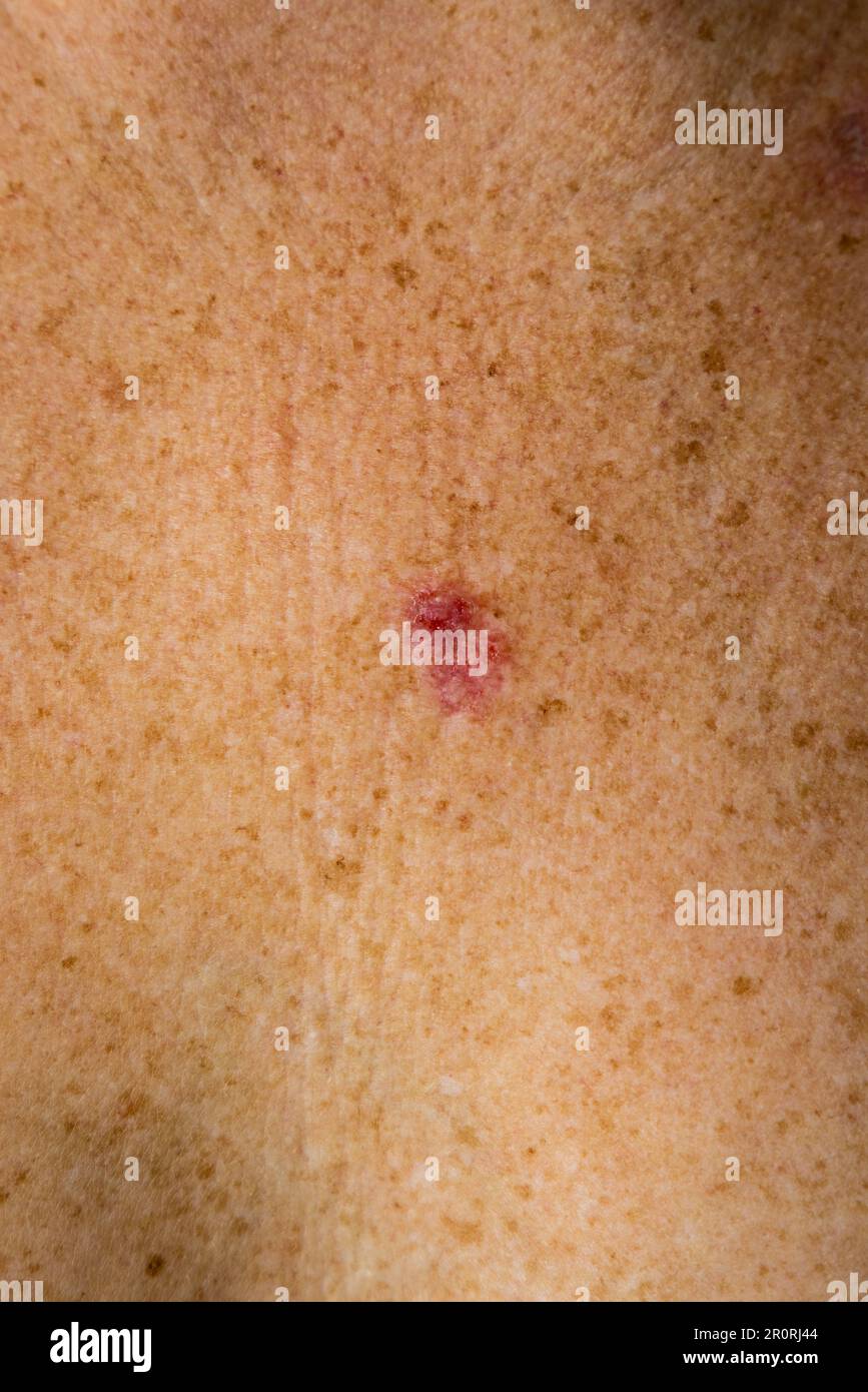 Macro view of superficial basal cell carcinoma showing red discoloration on young 30s caucasian female chest. Stock Photo