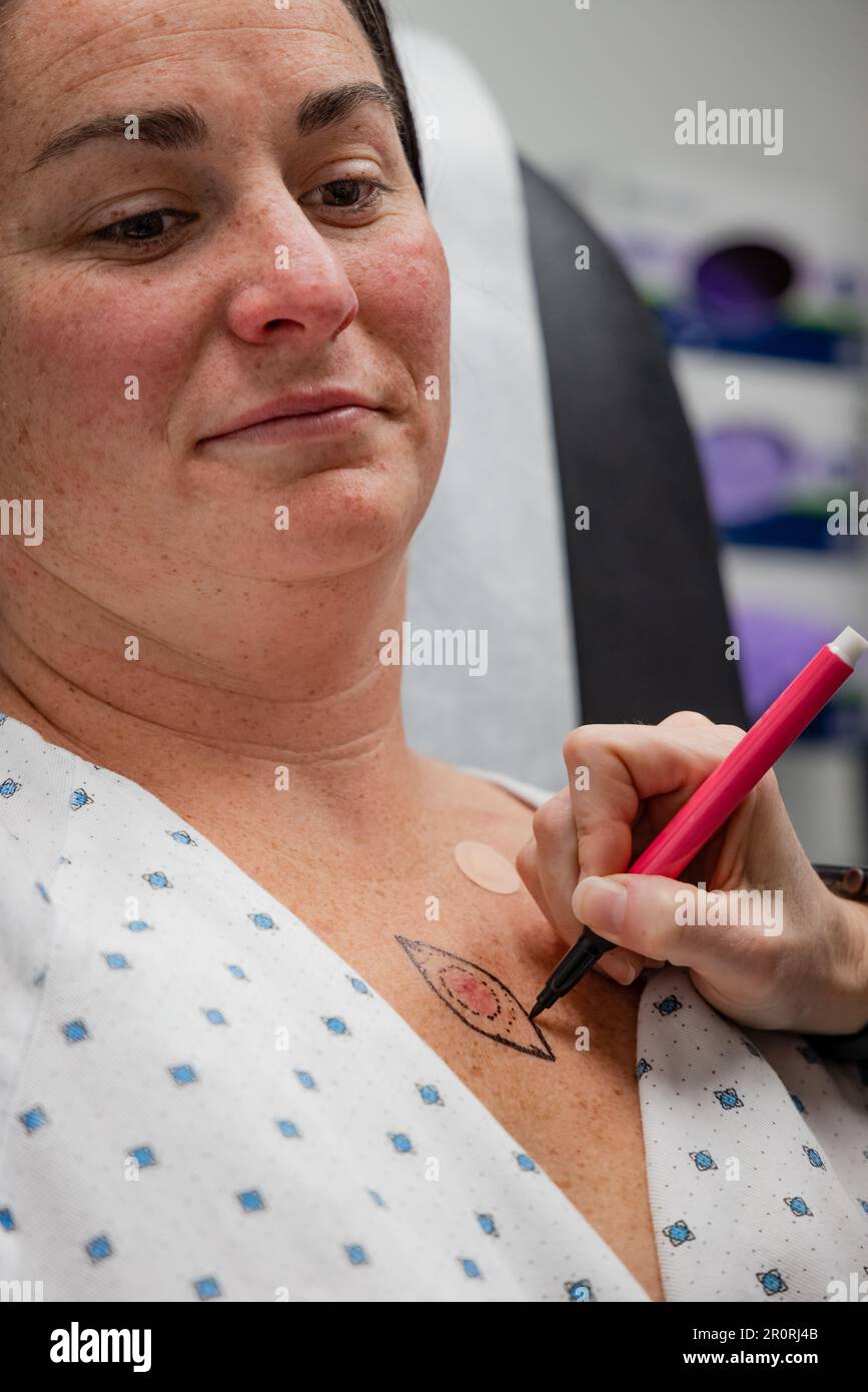 Dermatologist consults patient after drawing on young 30s woman chest for basal cell carcinoma excision procedure. Stock Photo