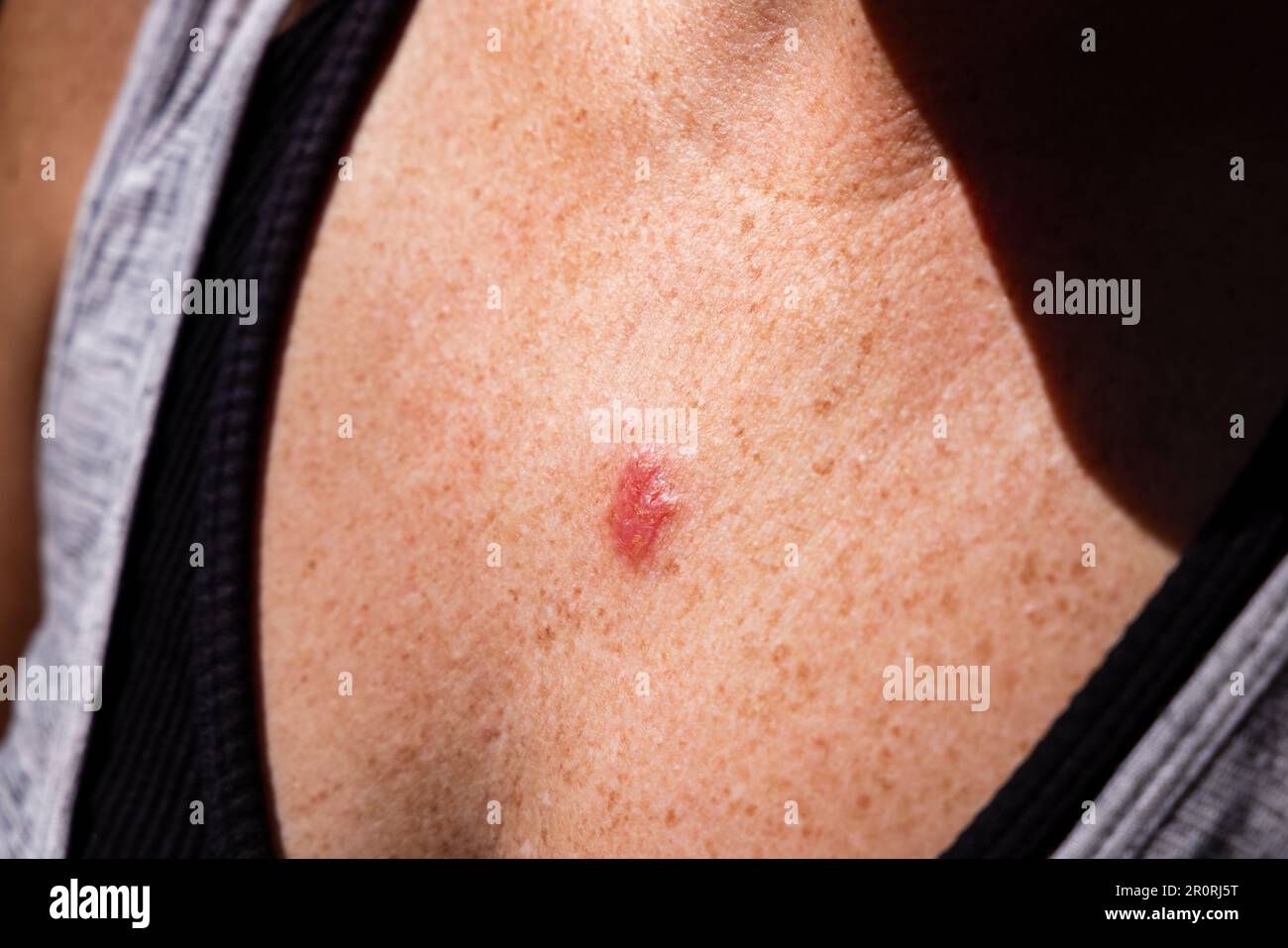 Young female 30s close up of chest prior to applying imiquimod cream