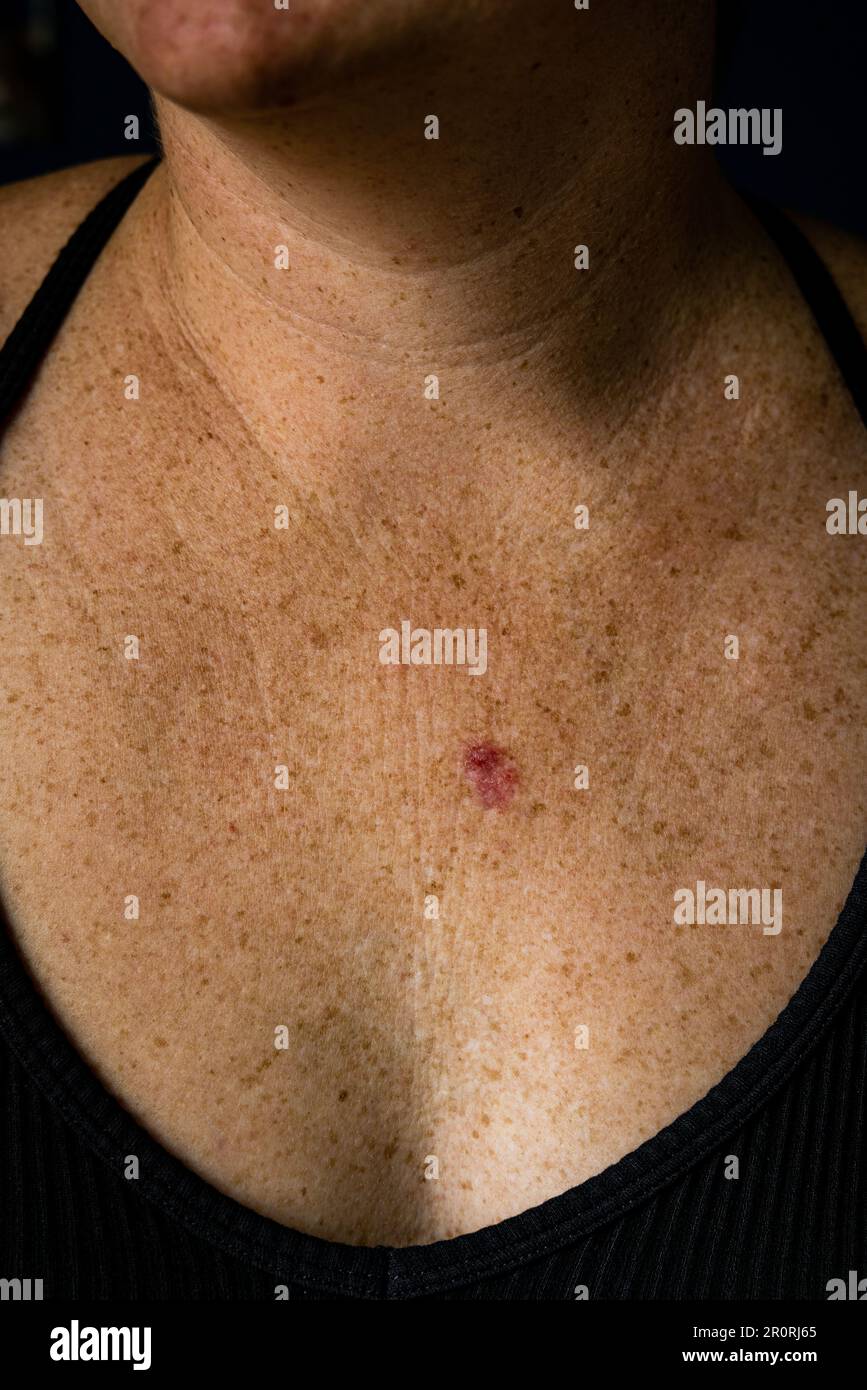 Vertical view of ulcerated sore superficial basal cell carcinoma red discoloration on young 30s caucasian female chest. Stock Photo