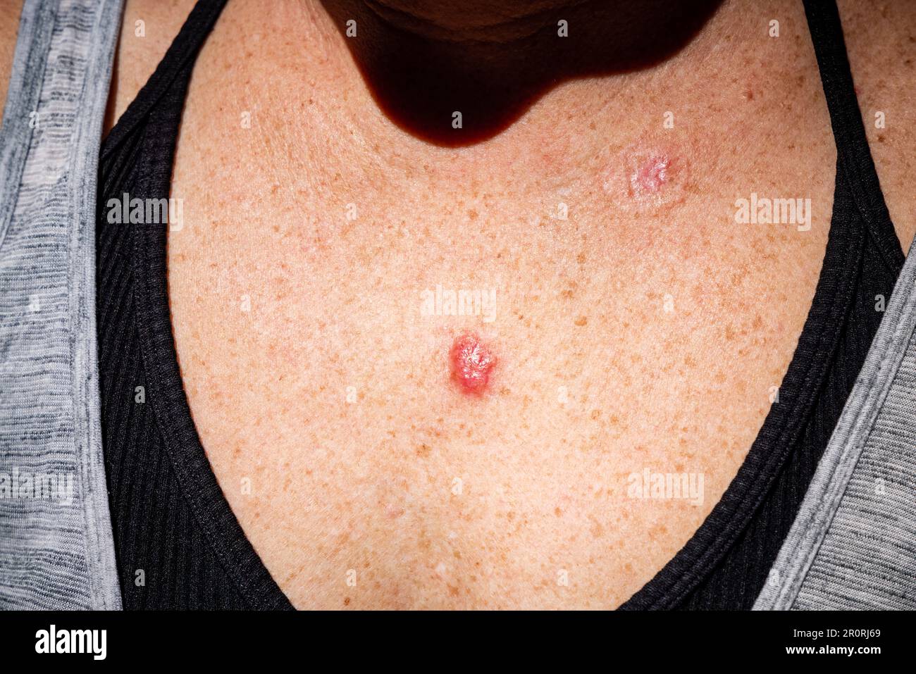 Young female 30s close up of chest prior to applying imiquimod cream