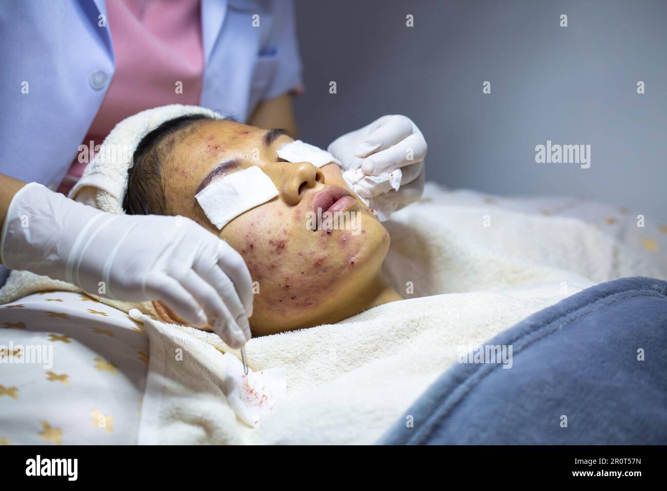 Acne extraction in a beauty clinic. Skin inflammation. The concept of