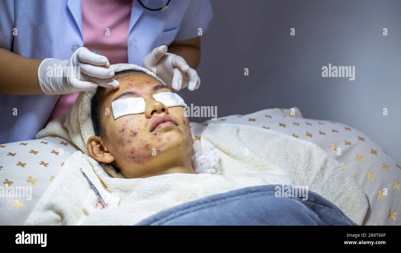 The problem of acne on the face Skin inflammation. The concept of ...