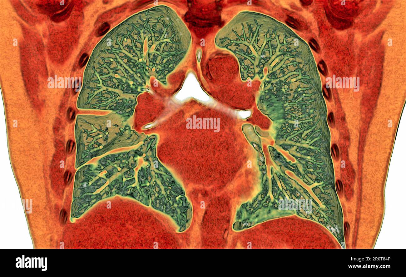 Pleural effusion, CT scan Stock Photo Alamy