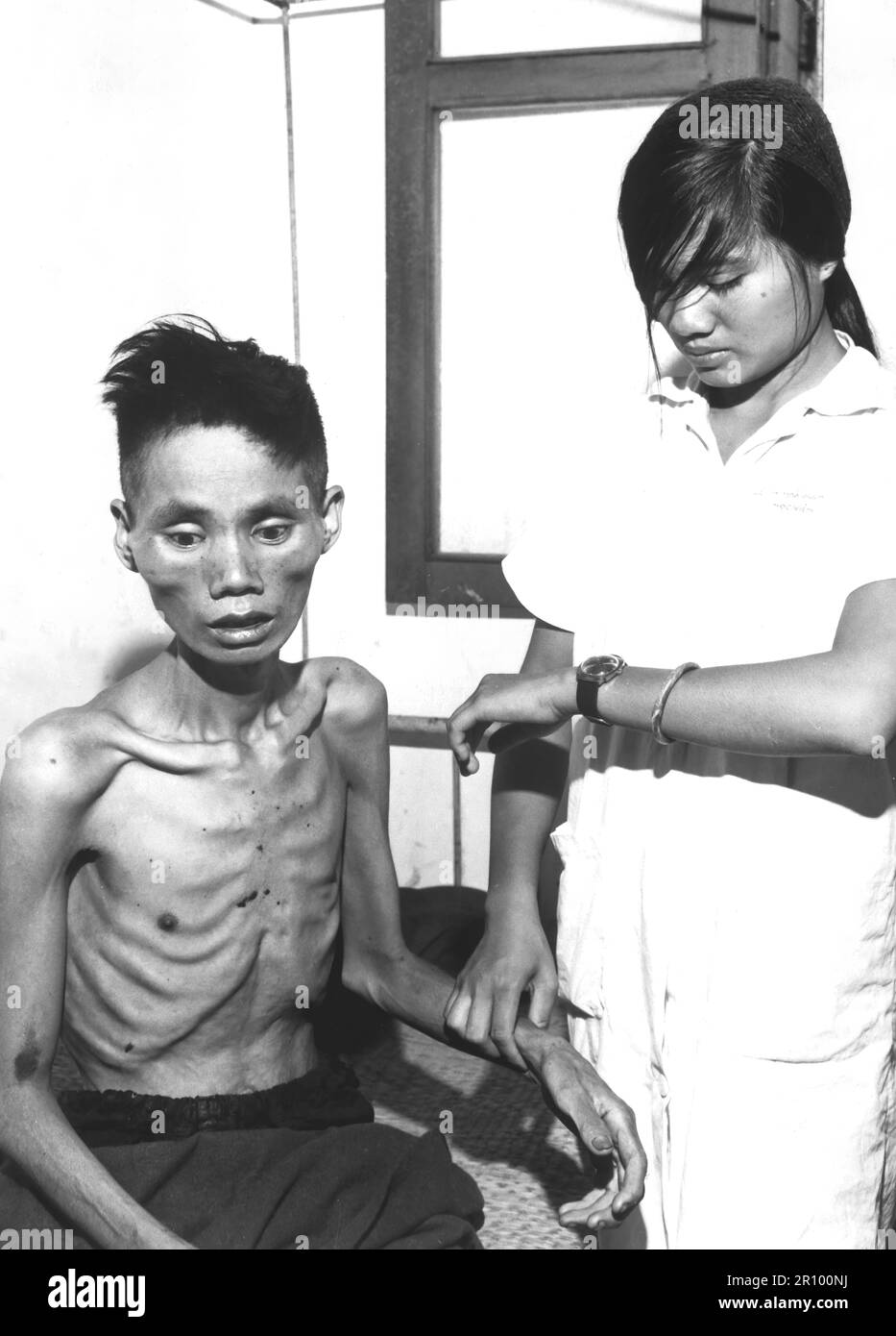 The effects of just one month spent in a Viet Cong prison camp show on 23-year-old Le Van Than, who had defected from the Communist forces and joined the Government side, was recaptured by the Viet Cong and deliberately starved.  Circa 1966. Stock Photo