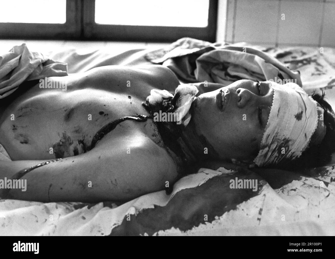 One of 48 persons wounded by a Viet Cong explosion which killed 14 persons in Saigon awaits treatment in the Cong Hoa Hospital. The blast was set off on a busy street corner and the victims included women and children.  February 1966. Stock Photo
