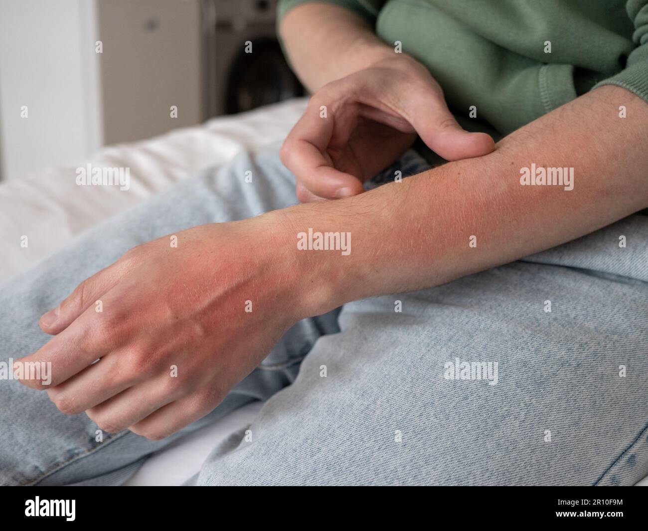 Man scratches hand, red damaged skin. Excoriation neurotic disorder, skin scratching, emotional stress or allergies. Stock Photo