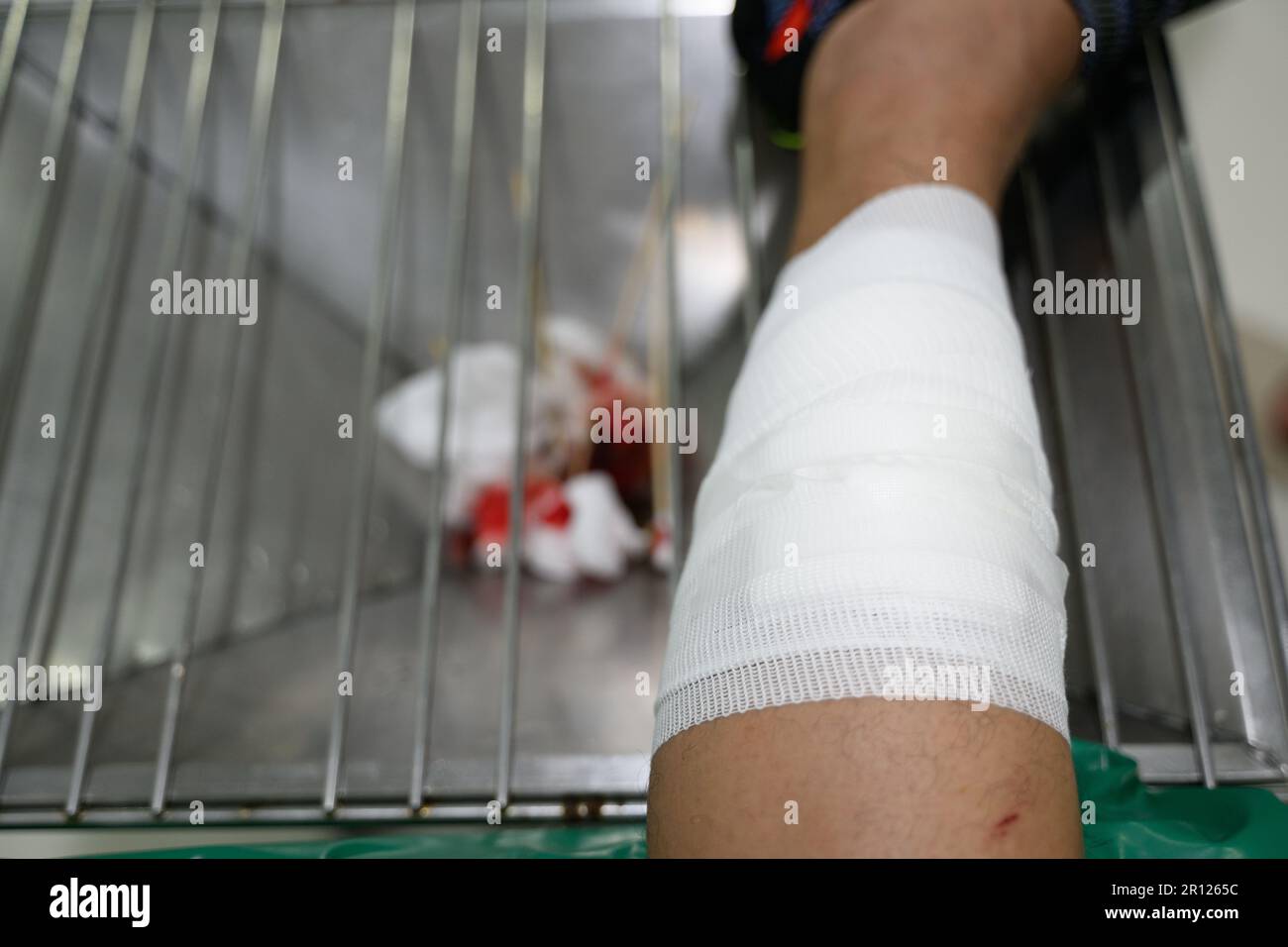 Nurses are treating a bleeding wound on the leg caused by an accident Stock Photo