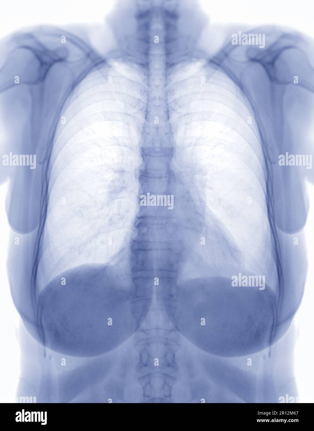 Chest x-ray image Negative filter Stock Photo - Alamy