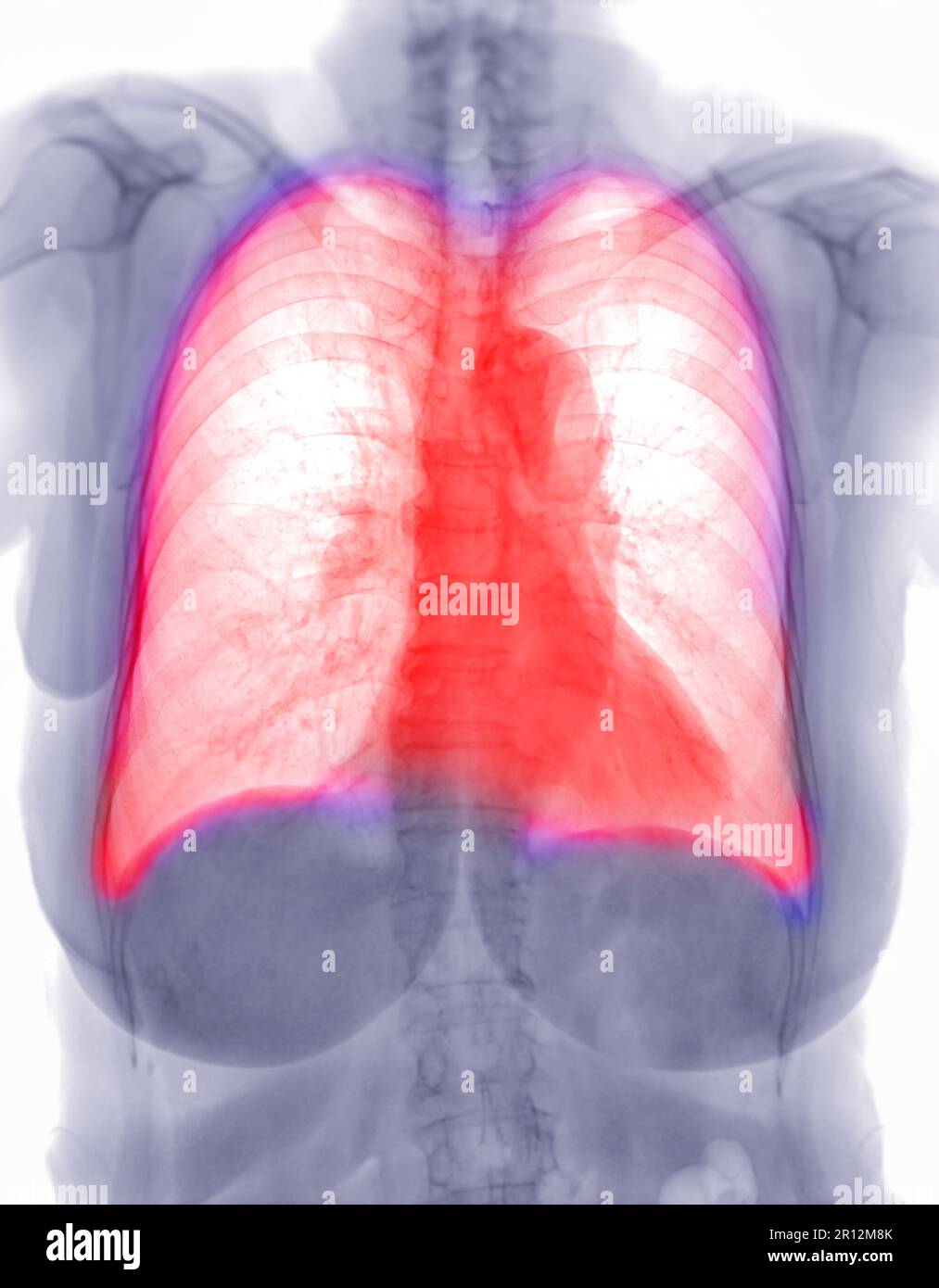 Chest x-ray image Negative filter. Stock Photo