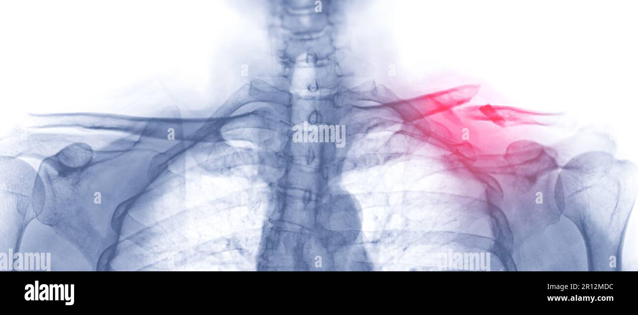 Xray of Clavicle AP view showing fracture of left Clavicle bone Stock