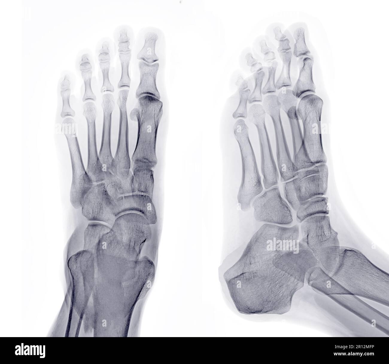 Foot xray image AP and Oblique view isolated on white background Stock