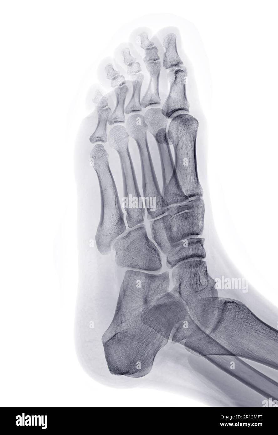 Foot xray image Oblique view isolated on White background Stock Photo