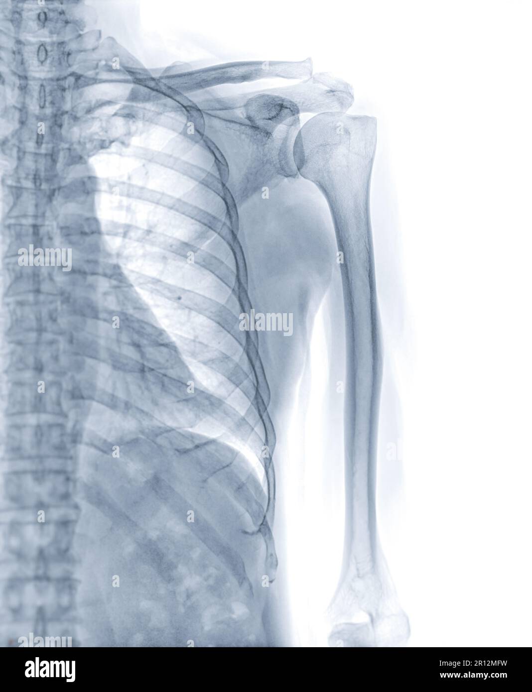 X-ray left Humerus bone for diagnosis fracture of Humerus bone . Stock Photo