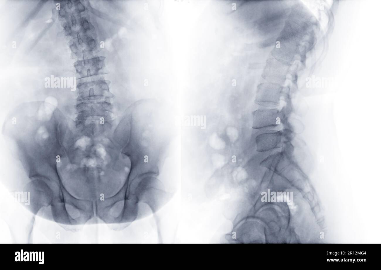 Xray image of lumbar Spine or Ls spine AP and lateral view for