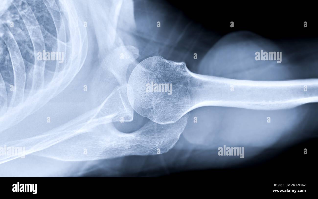 Xray Shoulder joint shoulder transaxillary view for diagnosis fracture of shoulder joint Stock