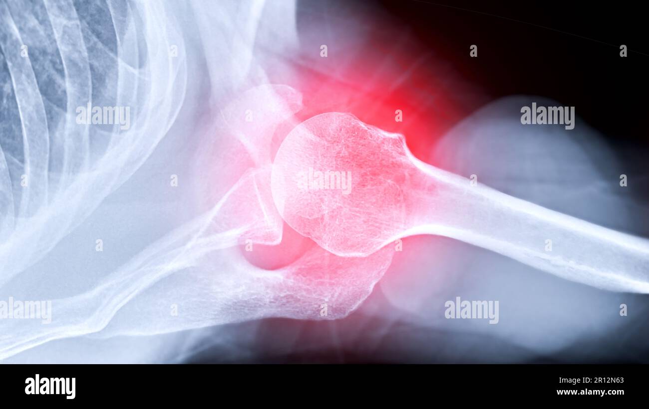 Xray Shoulder joint shoulder transaxillary view for diagnosis fracture of shoulder joint Stock