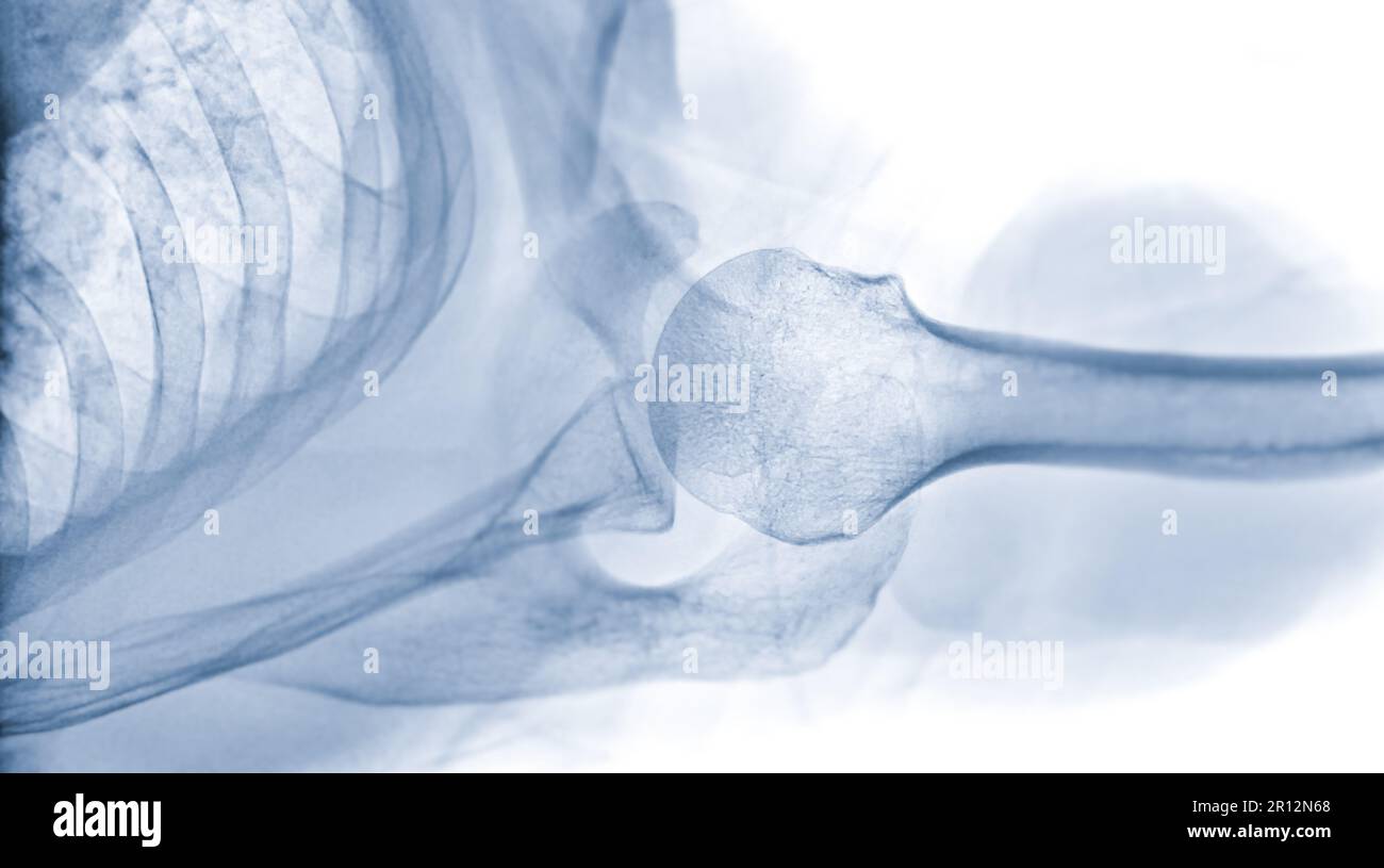 Xray Shoulder joint shoulder transaxillary view for diagnosis fracture of shoulder joint Stock