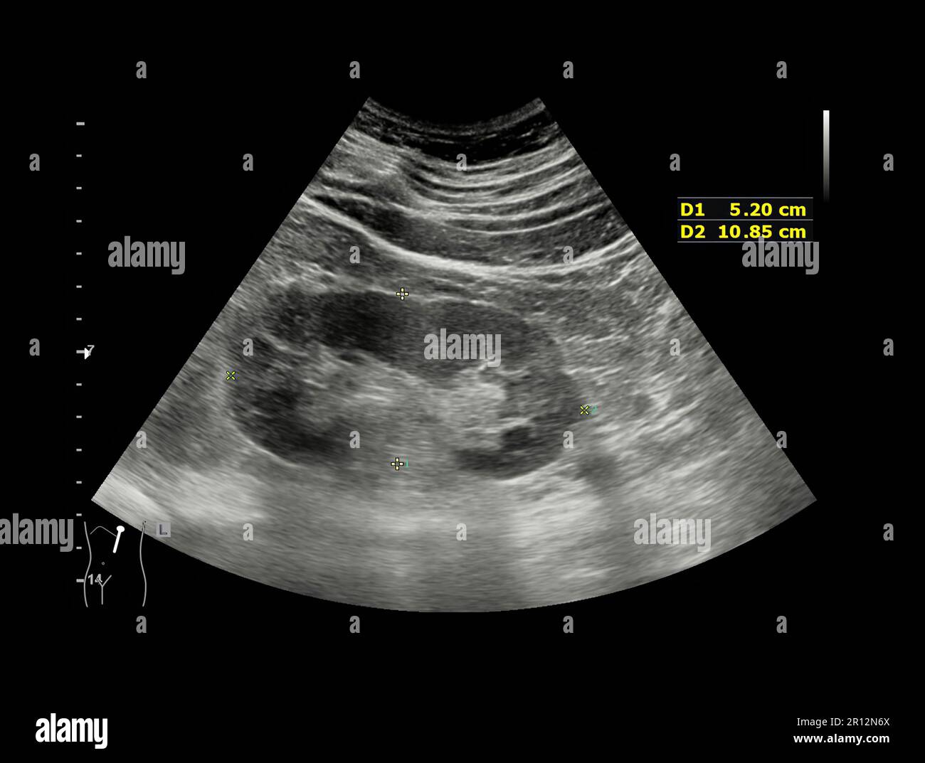 Ultrasound of Kidney  or KUB  for  screening  renal stone disease or Urolithiasis. Stock Photo