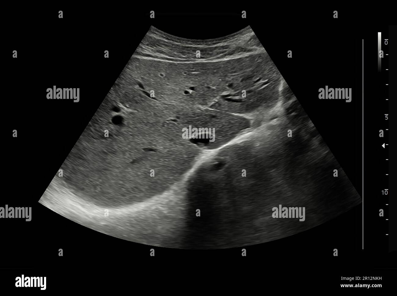 Ultrasound upper abdomen for diagnosis abdominal pain Stock Photo - Alamy