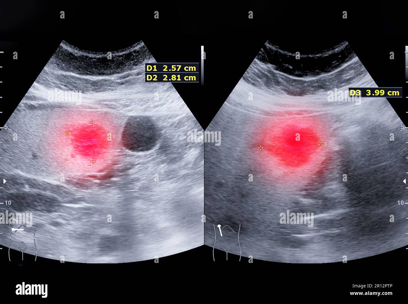 Ultrasound upper abdomen for diagnosis abdominal pain Stock Photo - Alamy