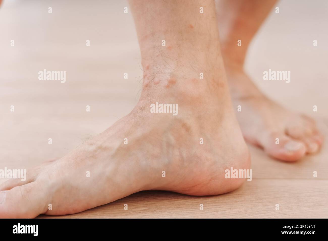 Close up allergic rash dermatitis eczema on man foot. Leg with red rash