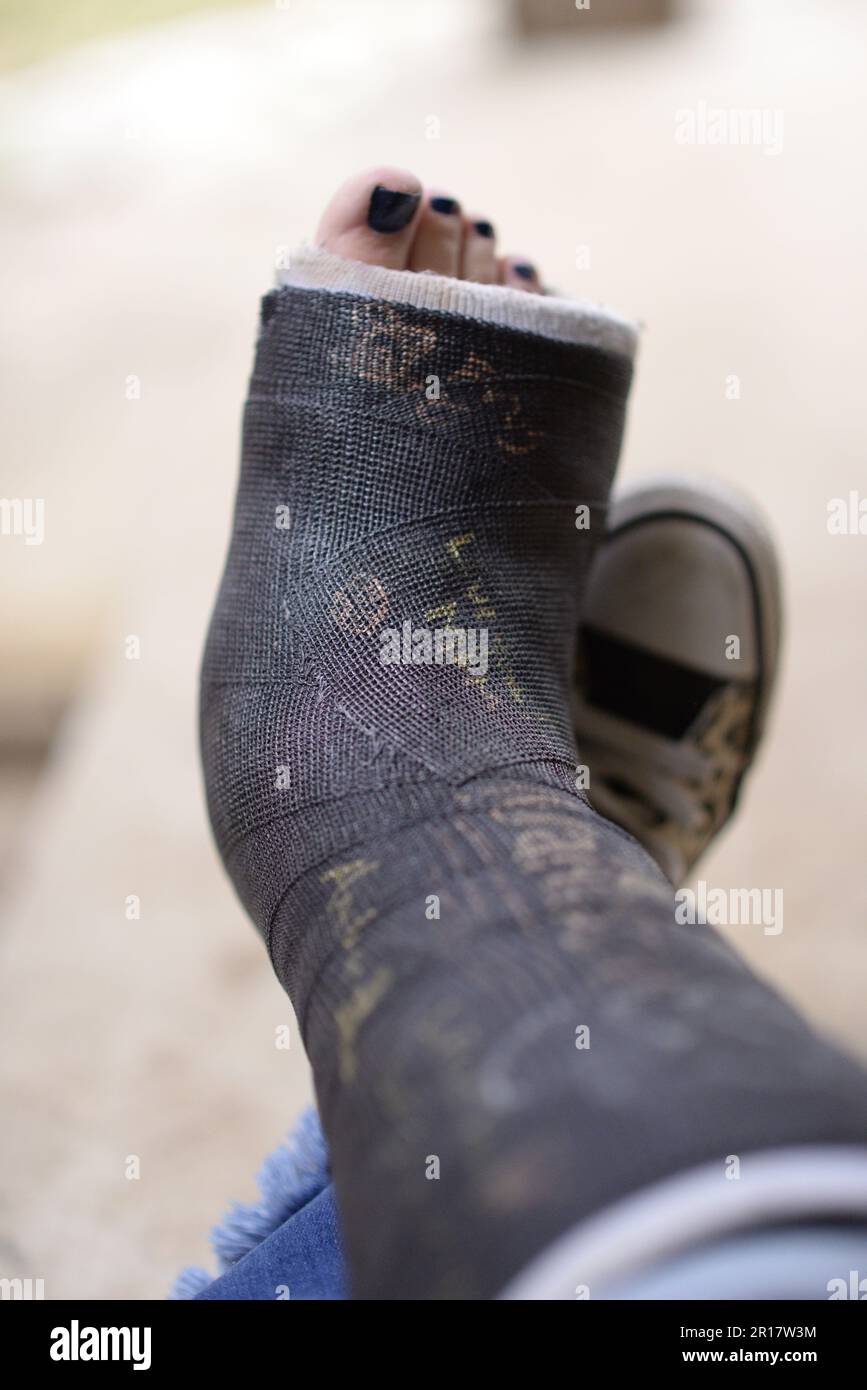 Broken leg cast hires stock photography and images Alamy