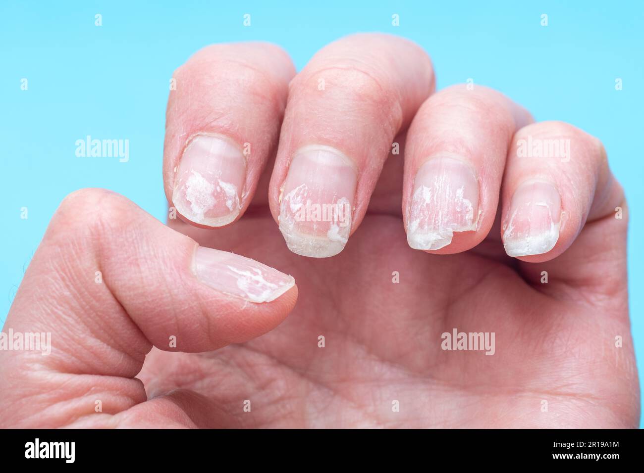 Flaky bitten and brittle nails without a manicure. Regrown nail cuticle and  damaged nail plate after gel polish on blue background Stock Photo - Alamy