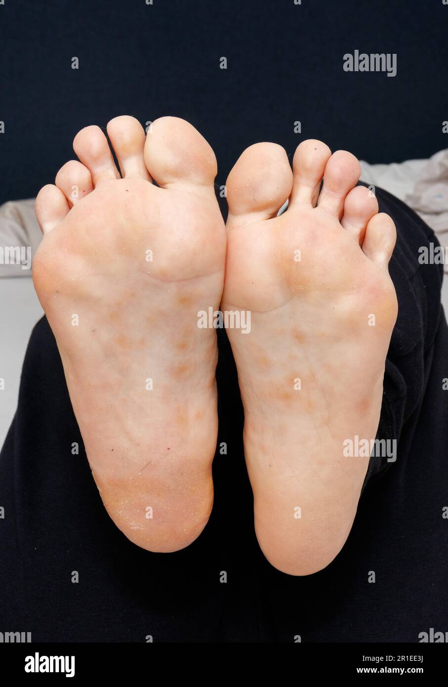 Dyshidrotic eczema on the sole of female feet Stock Photo