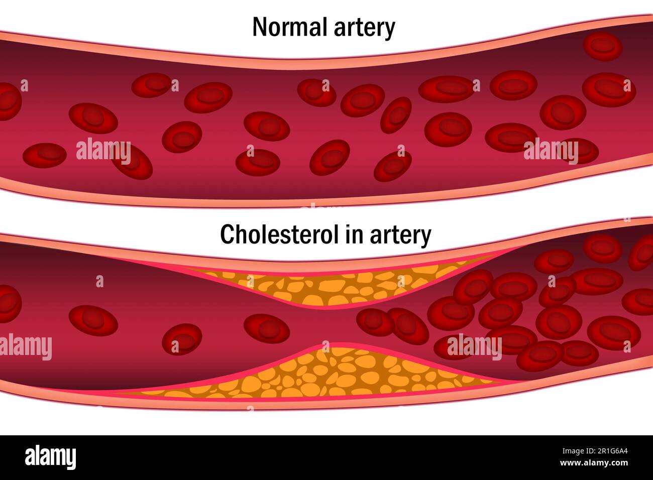 Cholesterol in artery. Medical concept, 3d rendering Stock Photo Alamy