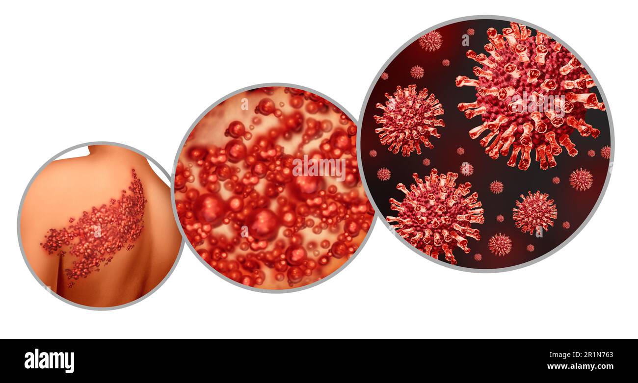 Shingles virus disease as a viral infection concept as a medical illustration with skin blisters hives and sores on a human back torso as a health Stock Photo