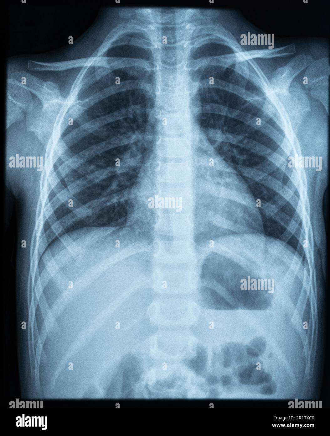 X ray photo image of chest area of young kid. X-ray lungs radiography Stock Photo