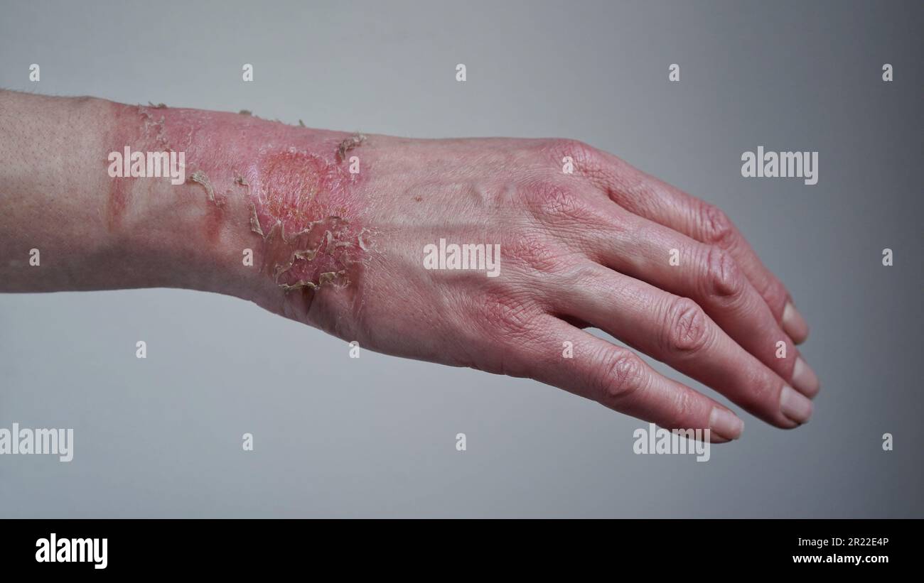 Closeup of a woman's hand with a burst blister from a boiled water