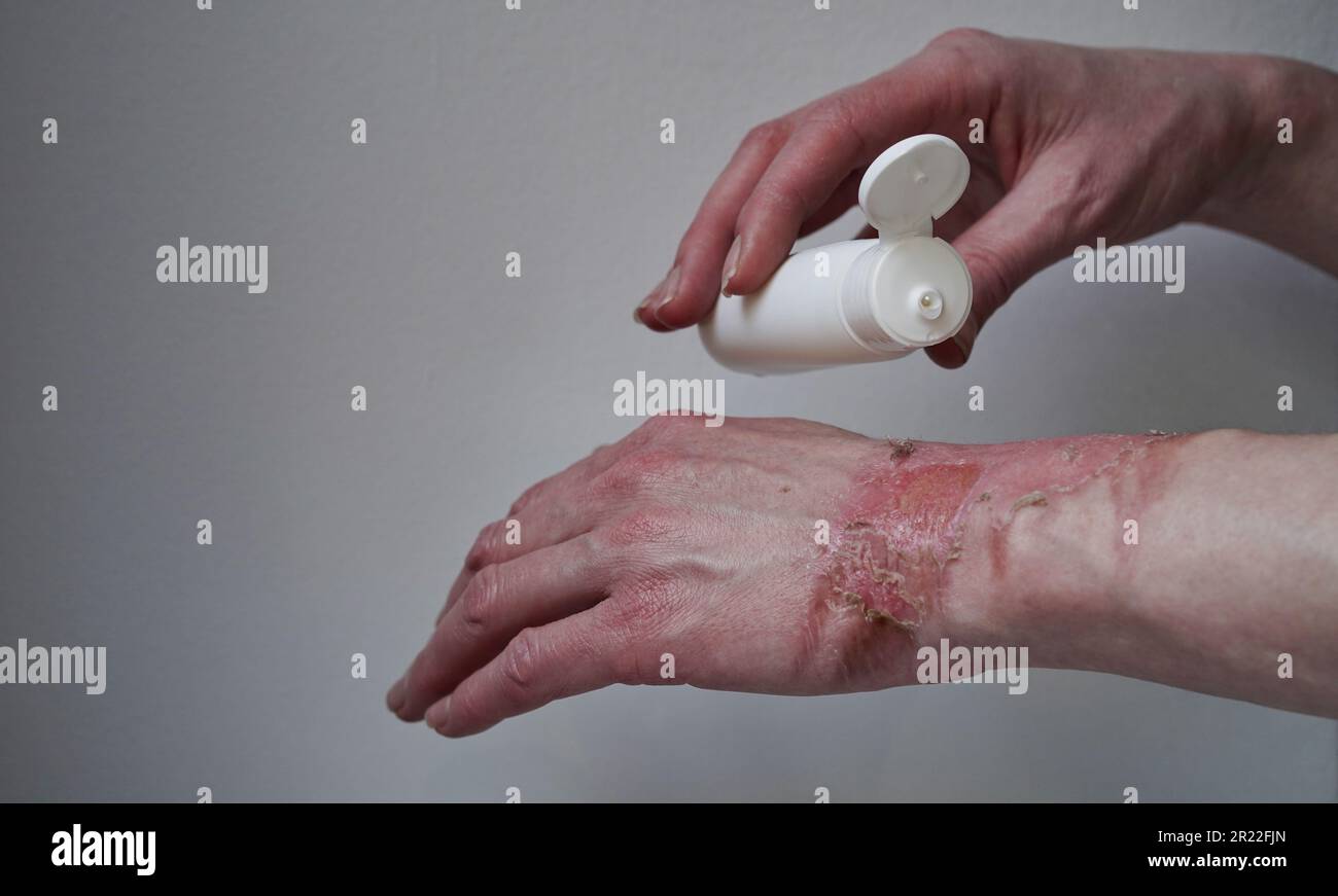 Mockup bottle with cream healing ointment woman hand burned with